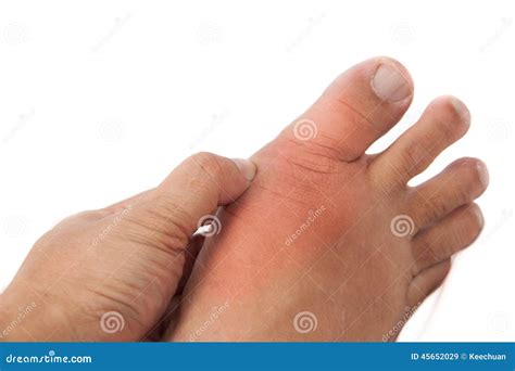 gikt hand.